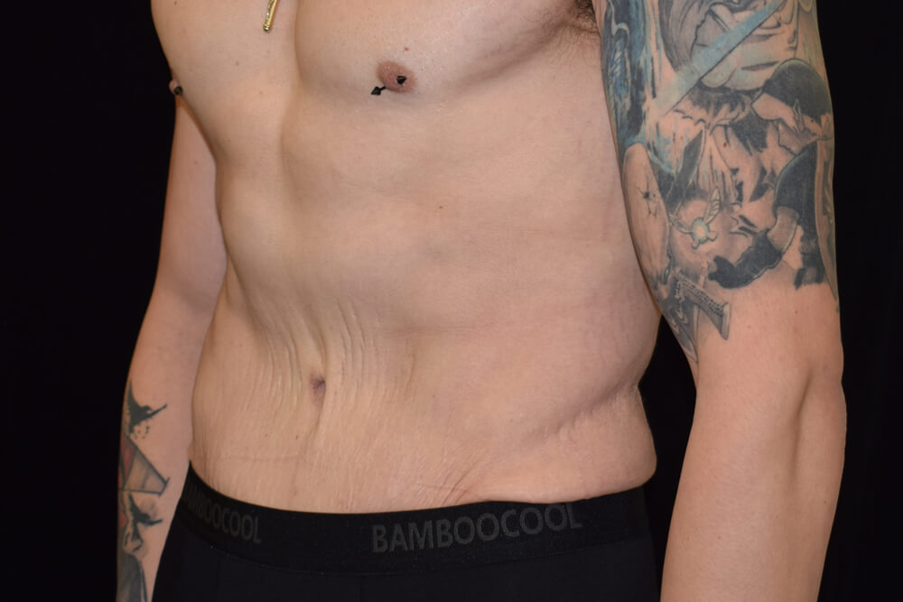 Tummy Tuck (abdominoplasty) - Dr. Joseph A. Racanelli Tummy Tuck (abdominoplasty)