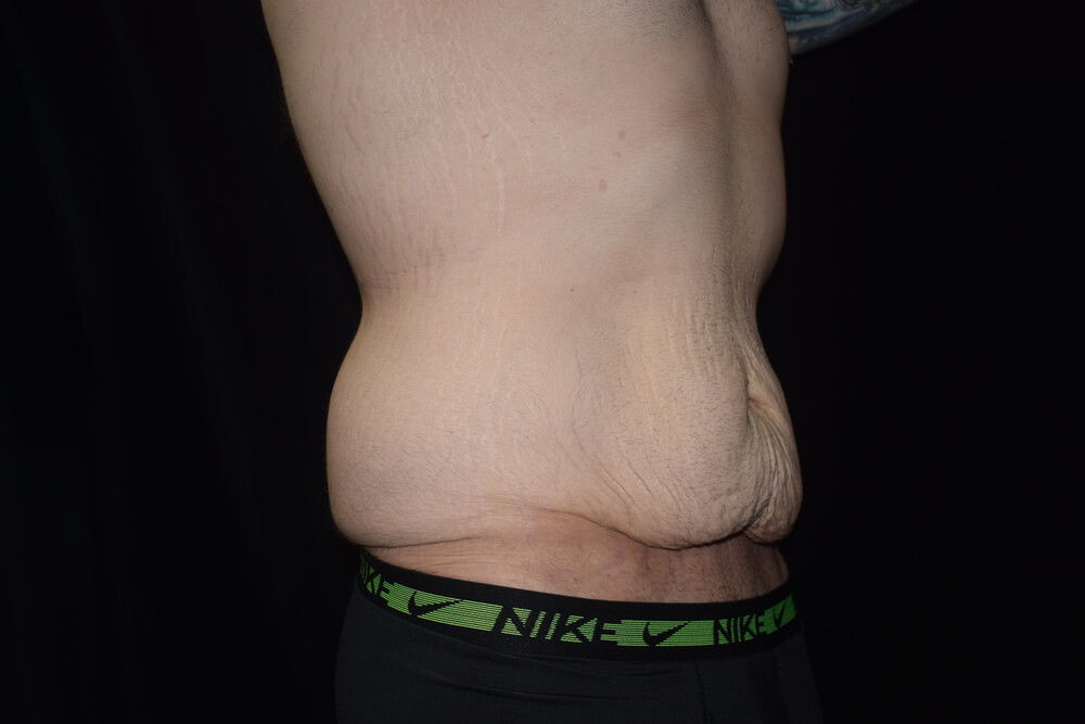 Tummy Tuck (abdominoplasty) - Dr. Joseph A. Racanelli Tummy Tuck (abdominoplasty)