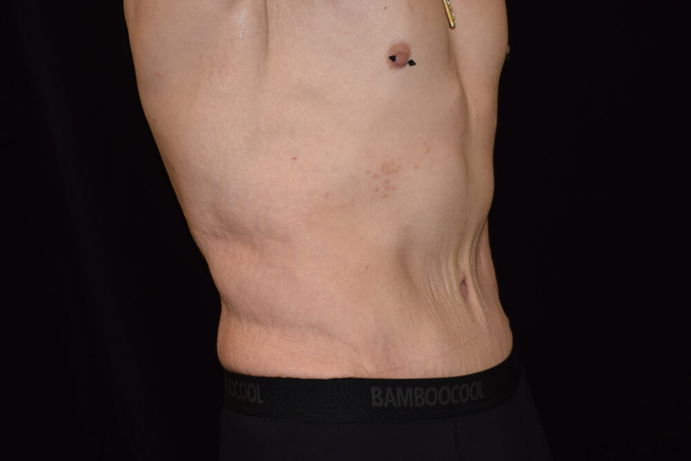 Tummy Tuck (abdominoplasty) - Dr. Joseph A. Racanelli Tummy Tuck (abdominoplasty)