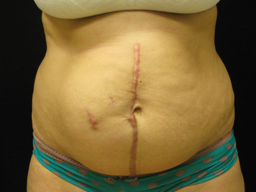 Tummy Tuck (abdominoplasty) - Dr. Joseph A. Racanelli Tummy Tuck (abdominoplasty)