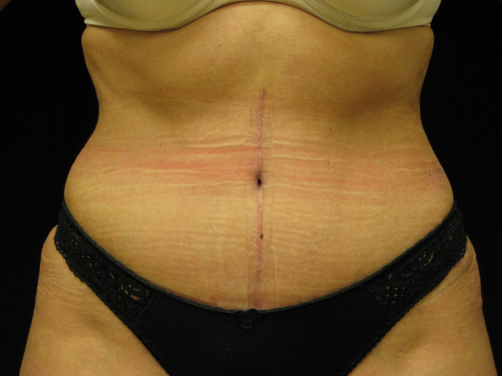 Tummy Tuck (abdominoplasty) - Dr. Joseph A. Racanelli Tummy Tuck (abdominoplasty)