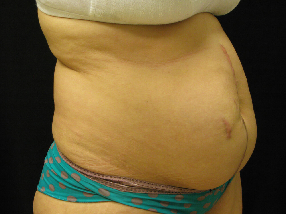 Tummy Tuck (abdominoplasty) - Dr. Joseph A. Racanelli Tummy Tuck (abdominoplasty)