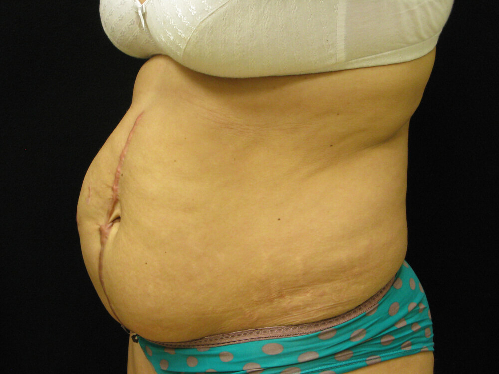 Tummy Tuck (abdominoplasty) - Dr. Joseph A. Racanelli Tummy Tuck (abdominoplasty)