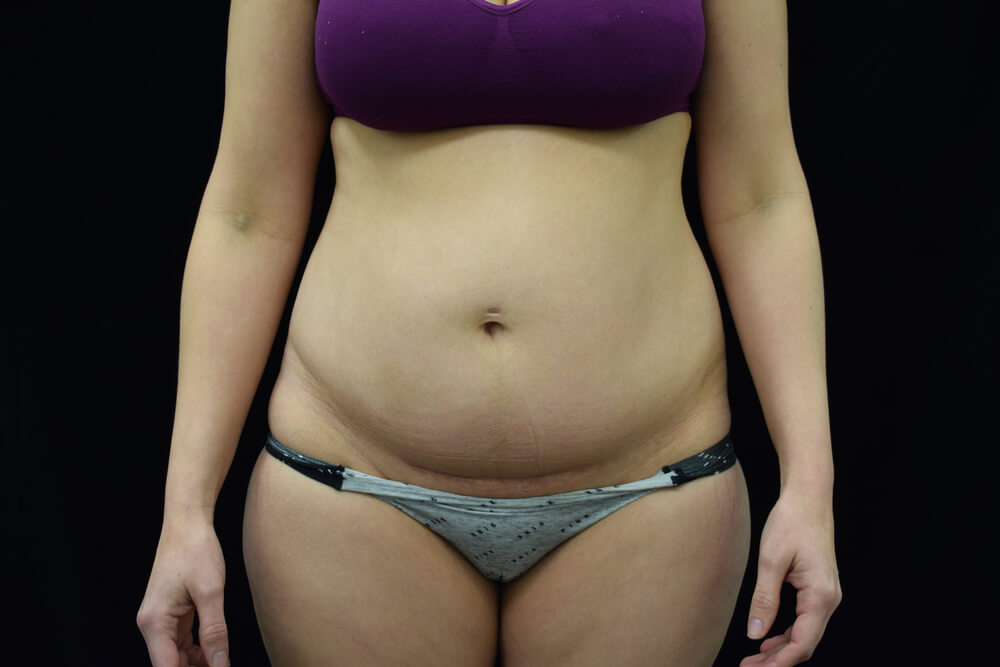 Tummy Tuck (abdominoplasty) - Dr. Joseph A. Racanelli Tummy Tuck (abdominoplasty)