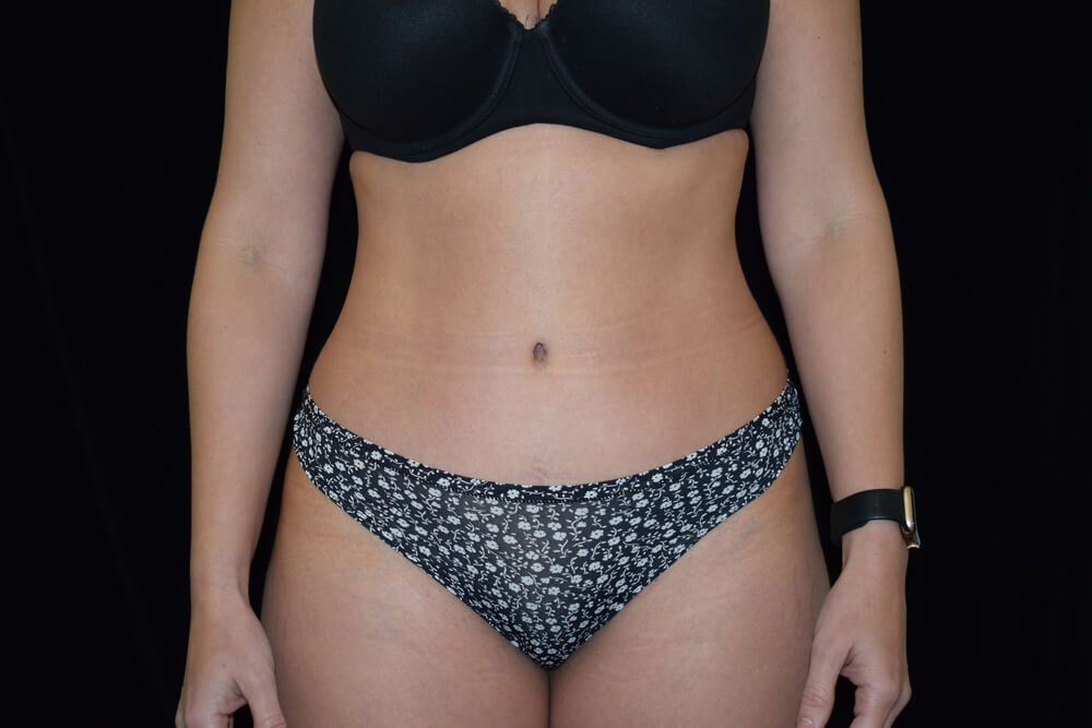 Tummy Tuck (abdominoplasty) - Dr. Joseph A. Racanelli Tummy Tuck (abdominoplasty)