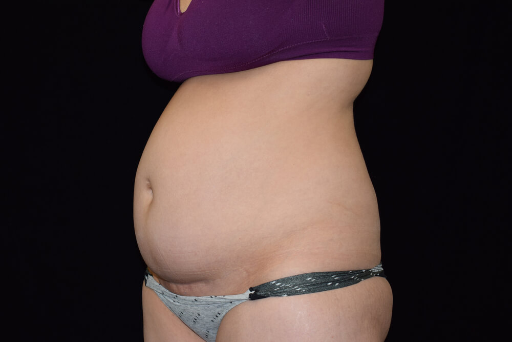 Tummy Tuck (abdominoplasty) - Dr. Joseph A. Racanelli Tummy Tuck (abdominoplasty)