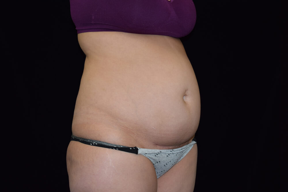 Tummy Tuck (abdominoplasty) - Dr. Joseph A. Racanelli Side view of a woman's torso in a purple bra and gray underwear, showing a rounded belly.