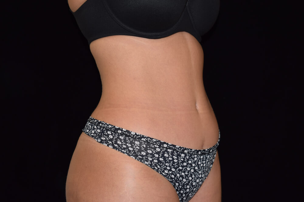 Tummy Tuck (abdominoplasty) - Dr. Joseph A. Racanelli Tummy Tuck (abdominoplasty)