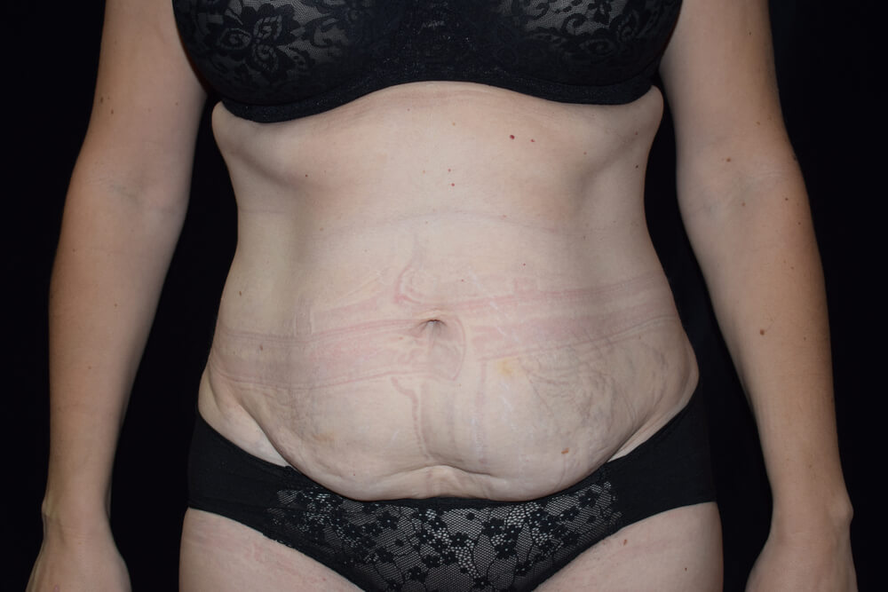 Tummy Tuck (abdominoplasty) - Dr. Joseph A. Racanelli Tummy Tuck (abdominoplasty)