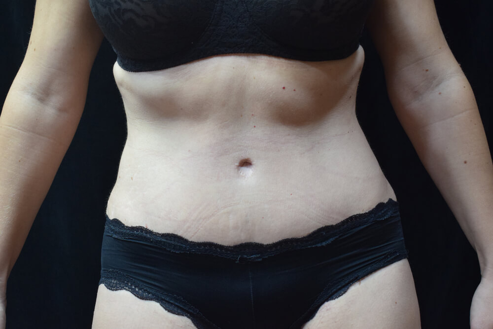 Tummy Tuck (abdominoplasty) - Dr. Joseph A. Racanelli Tummy Tuck (abdominoplasty)