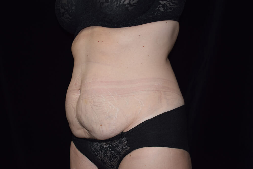 Tummy Tuck (abdominoplasty) - Dr. Joseph A. Racanelli Tummy Tuck (abdominoplasty)