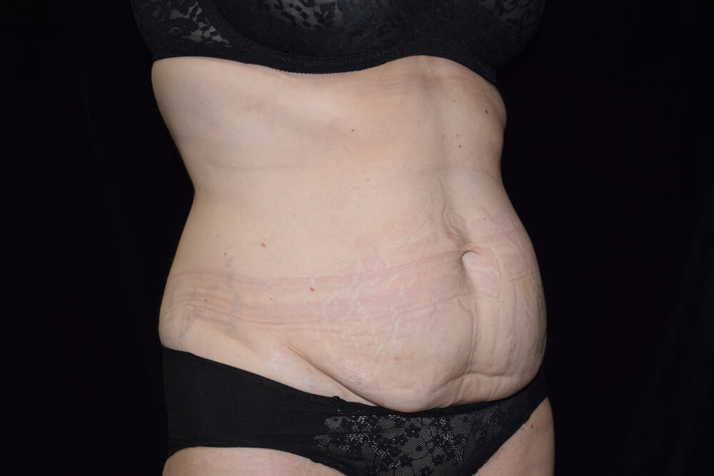 Tummy Tuck (abdominoplasty) - Dr. Joseph A. Racanelli Side view of a torso showing loose abdominal skin and stretch marks.