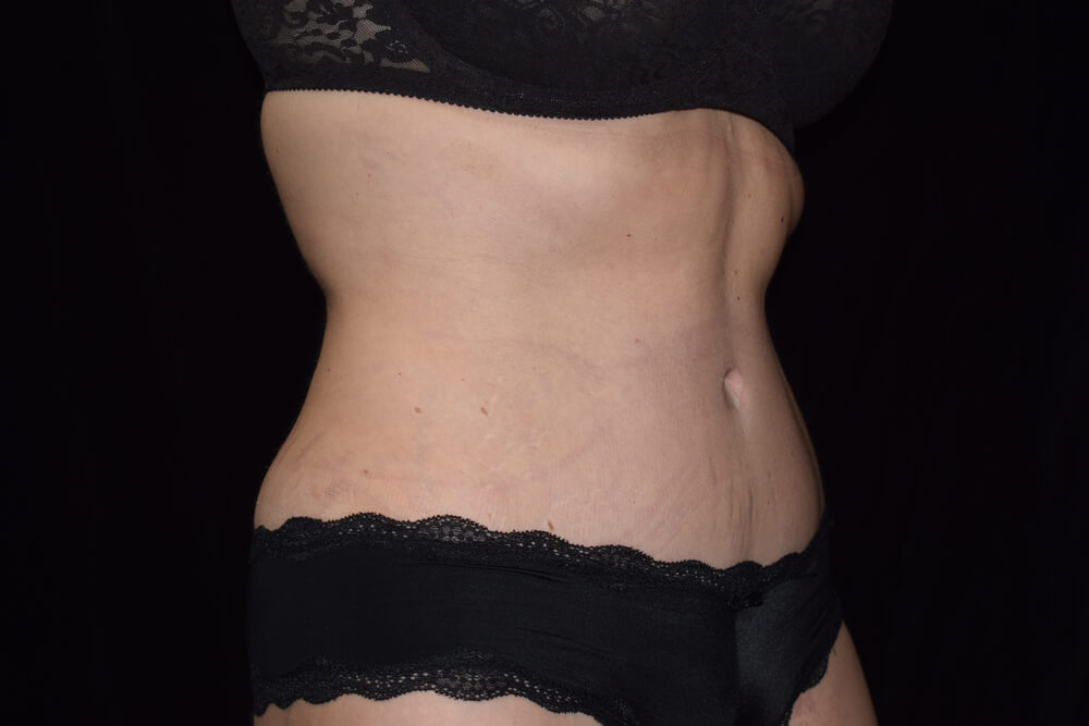 Tummy Tuck (abdominoplasty) - Dr. Joseph A. Racanelli Tummy Tuck (abdominoplasty)