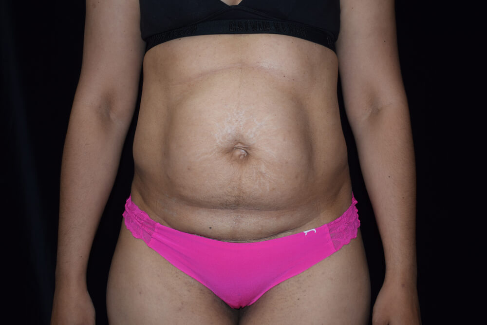 Tummy Tuck (abdominoplasty) - Dr. Joseph A. Racanelli Tummy Tuck (abdominoplasty)
