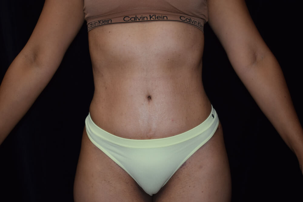 Tummy Tuck (abdominoplasty) - Dr. Joseph A. Racanelli Tummy Tuck (abdominoplasty)