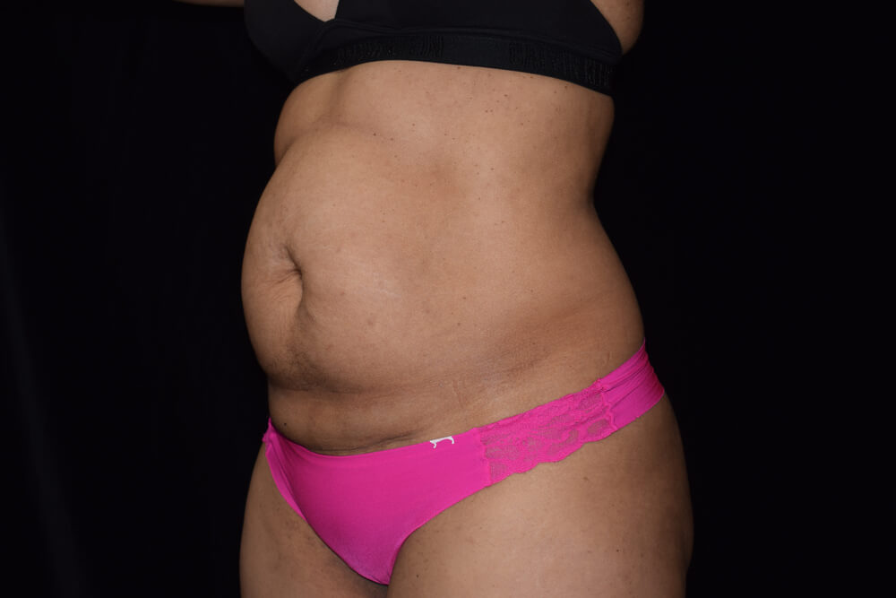 Tummy Tuck (abdominoplasty) - Dr. Joseph A. Racanelli Tummy Tuck (abdominoplasty)
