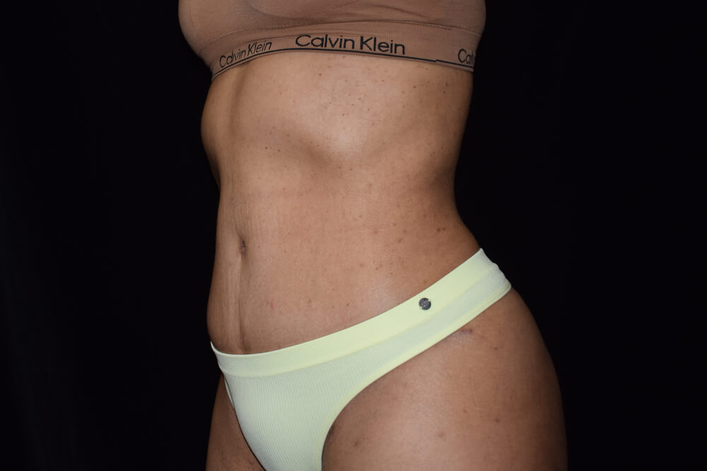 Tummy Tuck (abdominoplasty) - Dr. Joseph A. Racanelli Tummy Tuck (abdominoplasty)