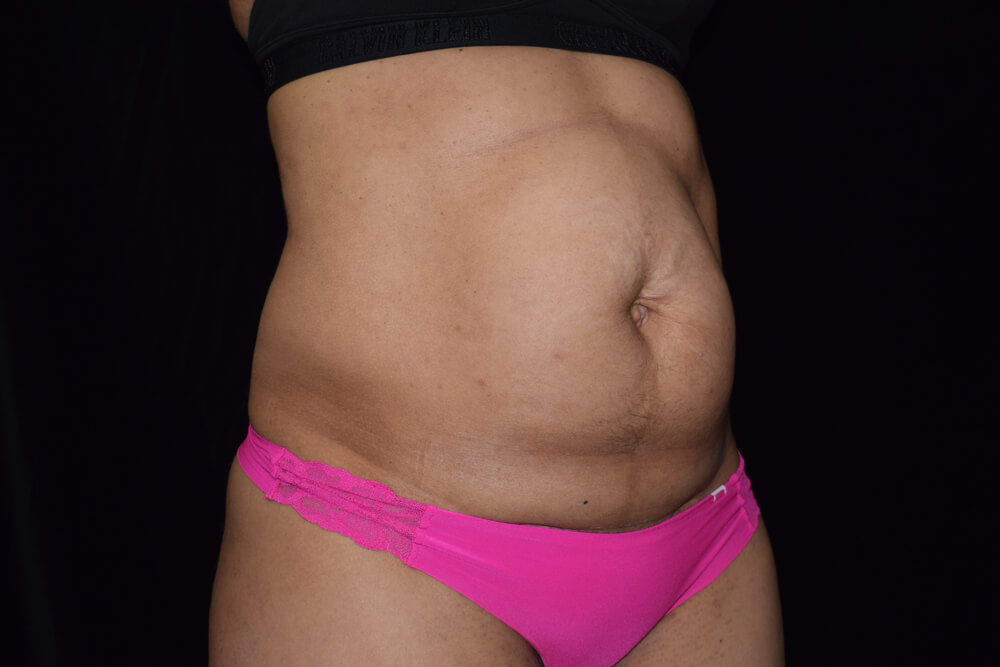 Tummy Tuck (abdominoplasty) - Dr. Joseph A. Racanelli Tummy Tuck (abdominoplasty)