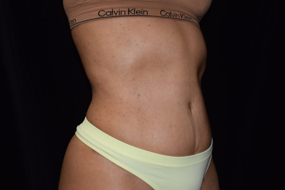 Tummy Tuck (abdominoplasty) - Dr. Joseph A. Racanelli Tummy Tuck (abdominoplasty)