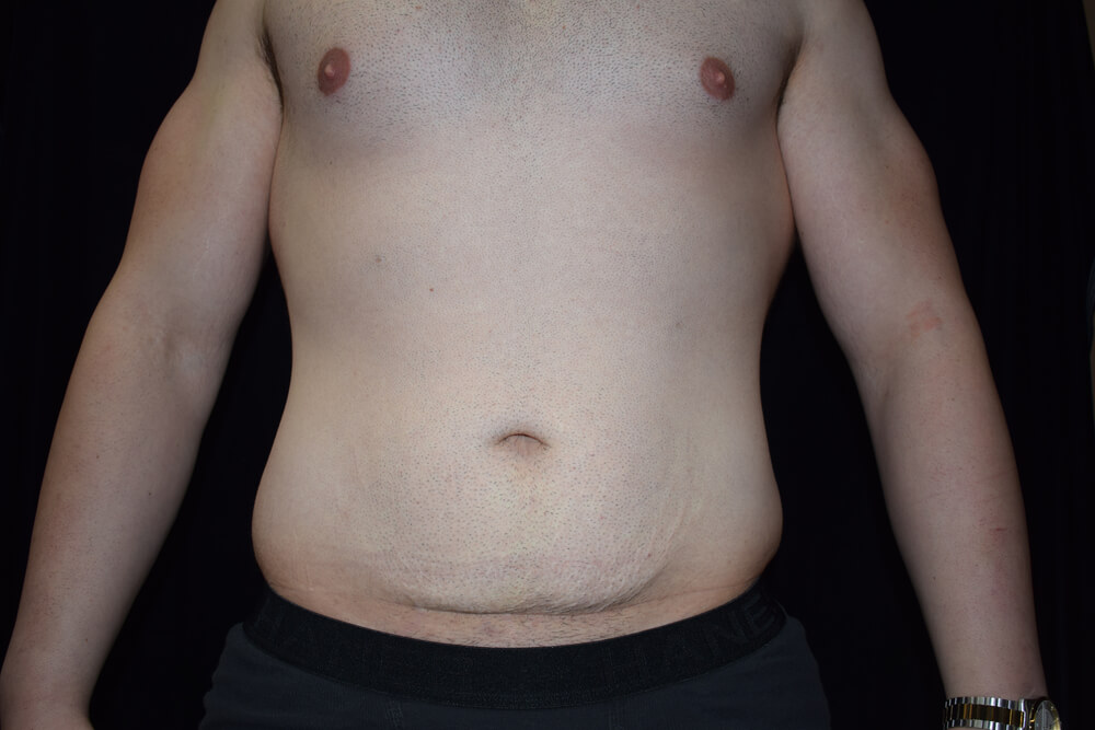Tummy Tuck (abdominoplasty) - Dr. Joseph A. Racanelli Tummy Tuck (abdominoplasty)