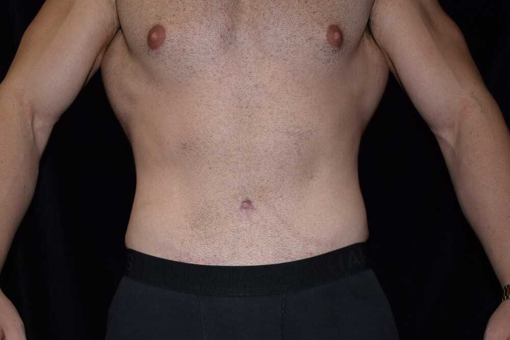 Tummy Tuck (abdominoplasty) - Dr. Joseph A. Racanelli Tummy Tuck (abdominoplasty)