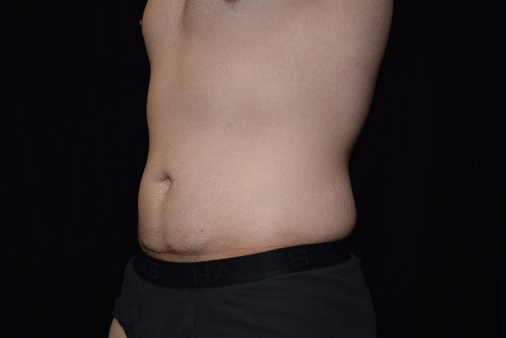 Tummy Tuck (abdominoplasty) - Dr. Joseph A. Racanelli Side view of a man's abdomen with a protruding belly and love handles, wearing black shorts against a dark background.