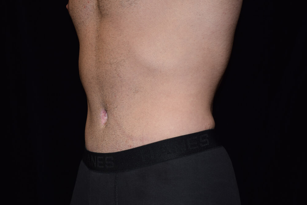 Tummy Tuck (abdominoplasty) - Dr. Joseph A. Racanelli Tummy Tuck (abdominoplasty)