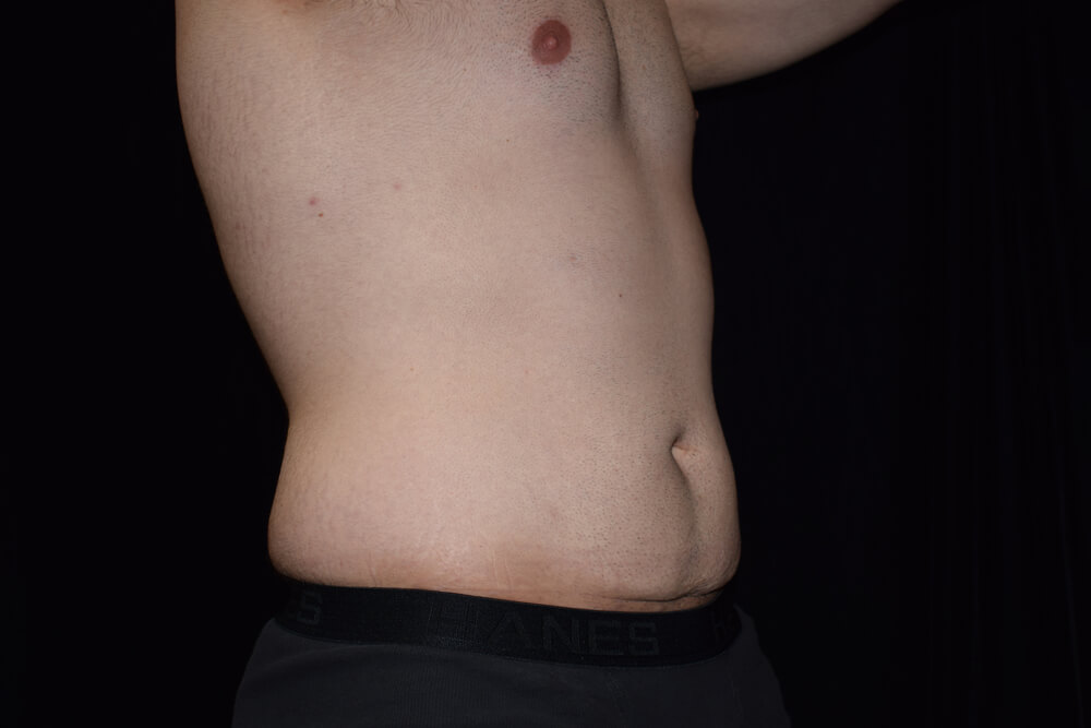 Tummy Tuck (abdominoplasty) - Dr. Joseph A. Racanelli Tummy Tuck (abdominoplasty)