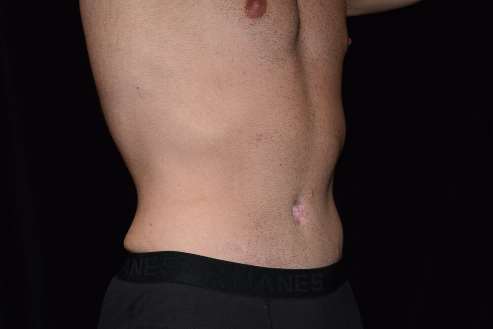 Tummy Tuck (abdominoplasty) - Dr. Joseph A. Racanelli Tummy Tuck (abdominoplasty)