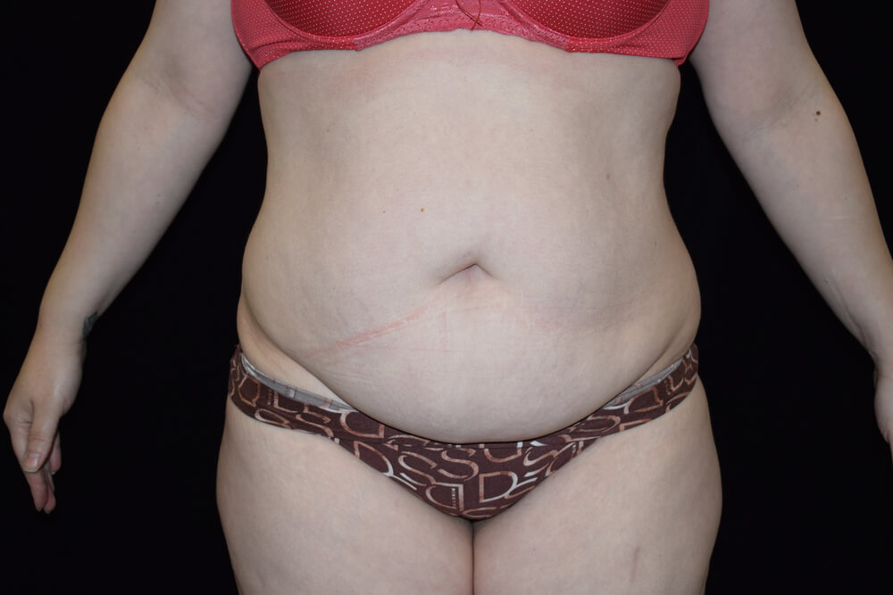 Tummy Tuck (abdominoplasty) - Dr. Joseph A. Racanelli Front view of a person in a red bra and brown patterned underwear, showing the abdomen with a faint horizontal scar and loose skin neural.