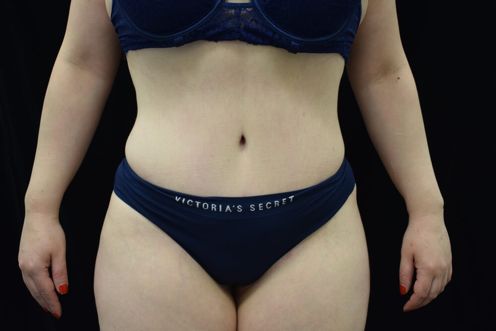 Tummy Tuck (abdominoplasty) - Dr. Joseph A. Racanelli Tummy Tuck (abdominoplasty)