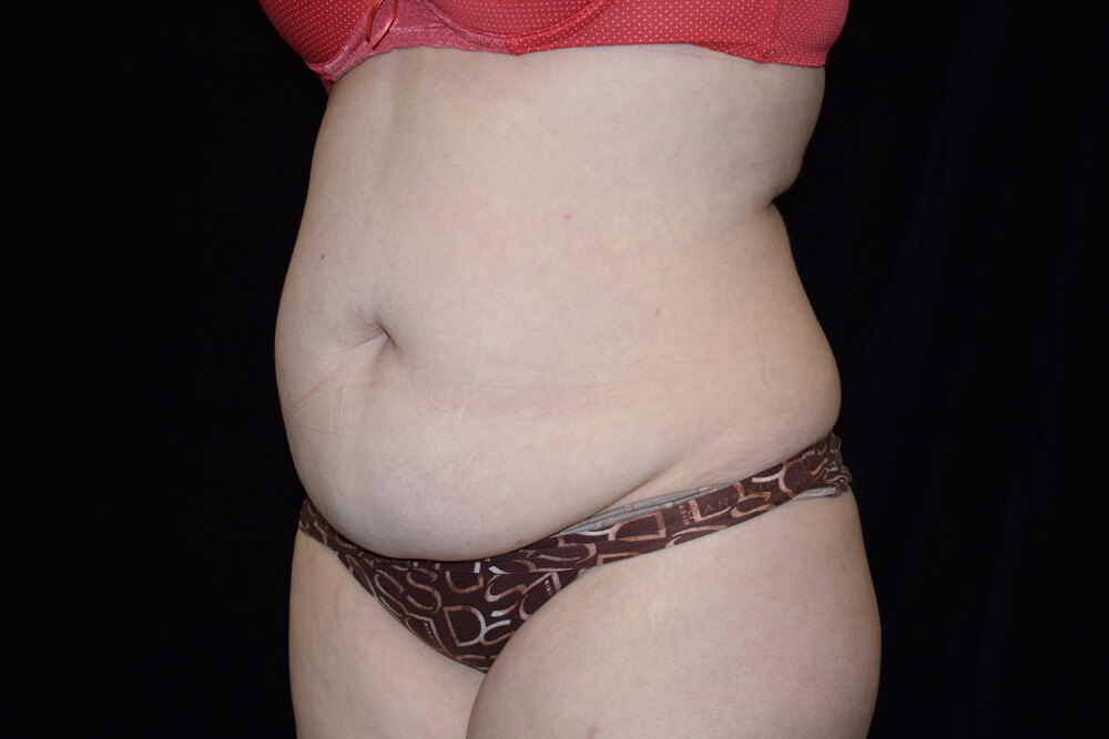 Tummy Tuck (abdominoplasty) - Dr. Joseph A. Racanelli Tummy Tuck (abdominoplasty)