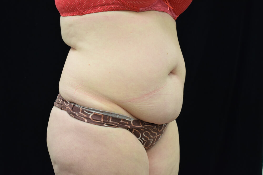 Tummy Tuck (abdominoplasty) - Dr. Joseph A. Racanelli Tummy Tuck (abdominoplasty)