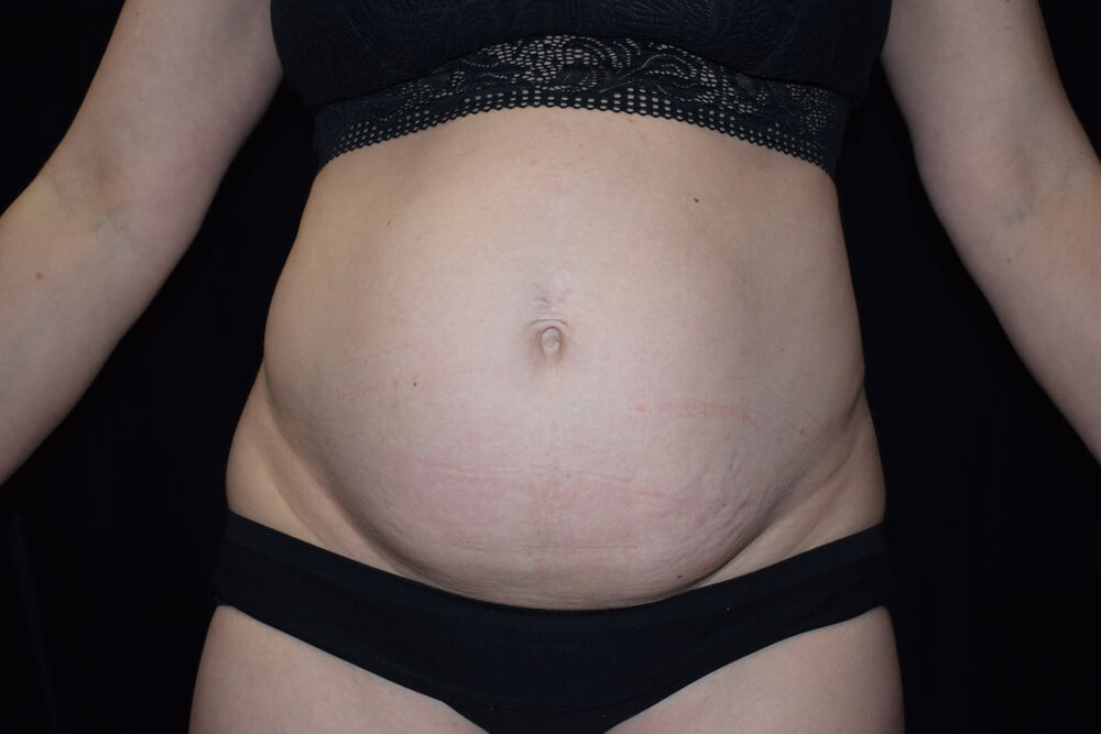Tummy Tuck (abdominoplasty) - Dr. Joseph A. Racanelli Tummy Tuck (abdominoplasty)