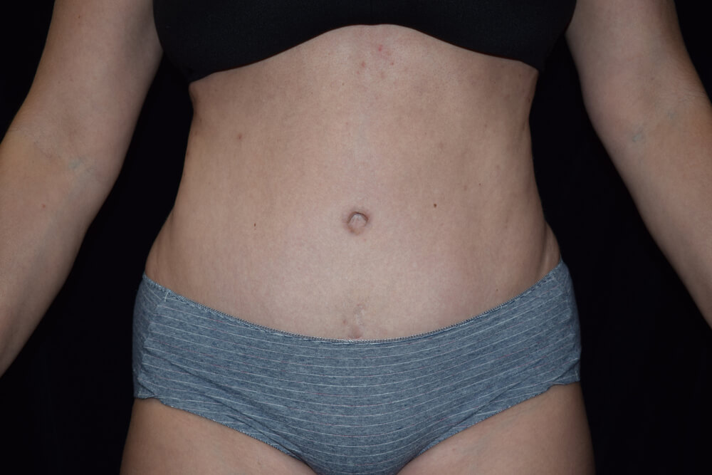 Tummy Tuck (abdominoplasty) - Dr. Joseph A. Racanelli Tummy Tuck (abdominoplasty)