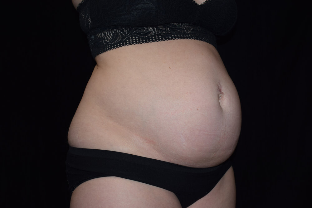 Tummy Tuck (abdominoplasty) - Dr. Joseph A. Racanelli Tummy Tuck (abdominoplasty)