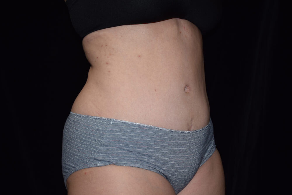 Tummy Tuck (abdominoplasty) - Dr. Joseph A. Racanelli Tummy Tuck (abdominoplasty)