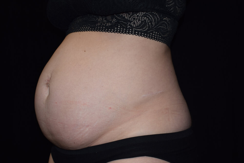 Tummy Tuck (abdominoplasty) - Dr. Joseph A. Racanelli Tummy Tuck (abdominoplasty)