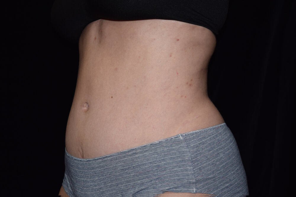 Tummy Tuck (abdominoplasty) - Dr. Joseph A. Racanelli Tummy Tuck (abdominoplasty)