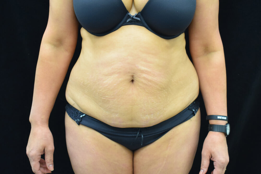 Tummy Tuck (abdominoplasty) - Dr. Joseph A. Racanelli Tummy Tuck (abdominoplasty)