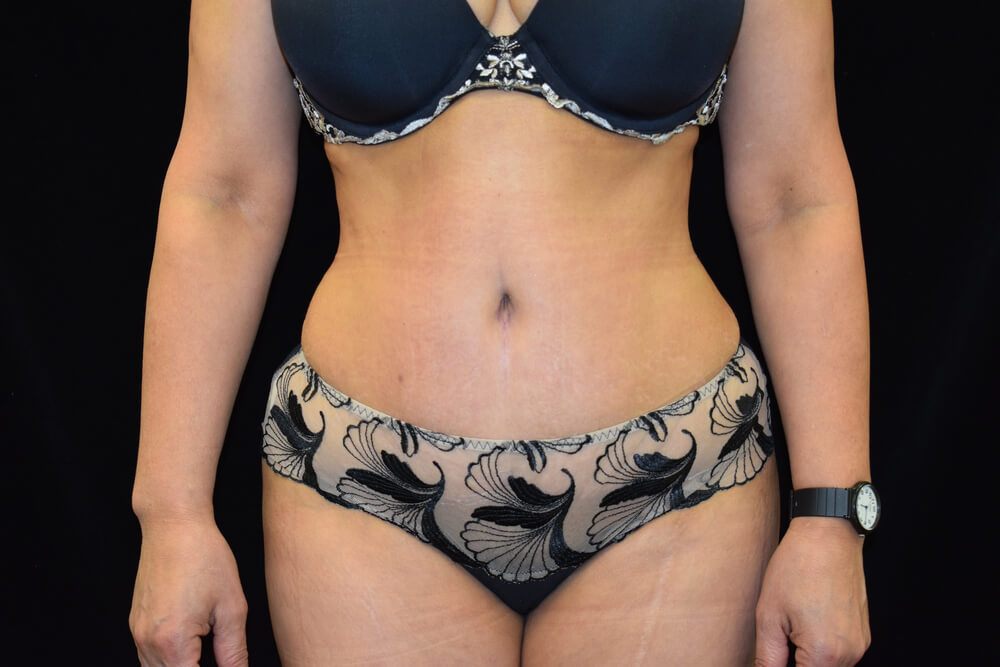 Tummy Tuck (abdominoplasty) - Dr. Joseph A. Racanelli Tummy Tuck (abdominoplasty)