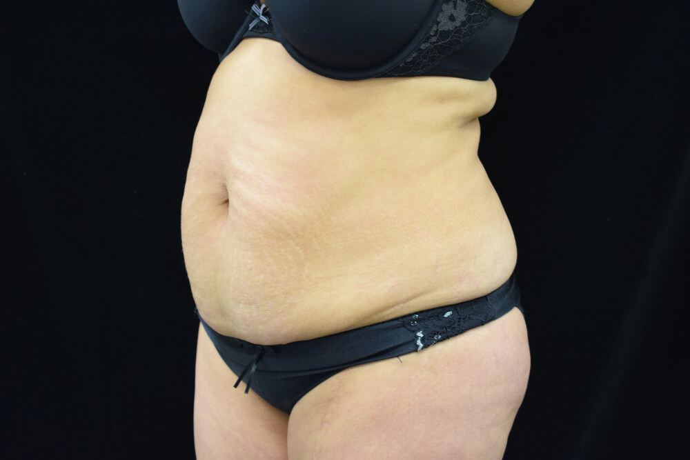 Tummy Tuck (abdominoplasty) - Dr. Joseph A. Racanelli Tummy Tuck (abdominoplasty)