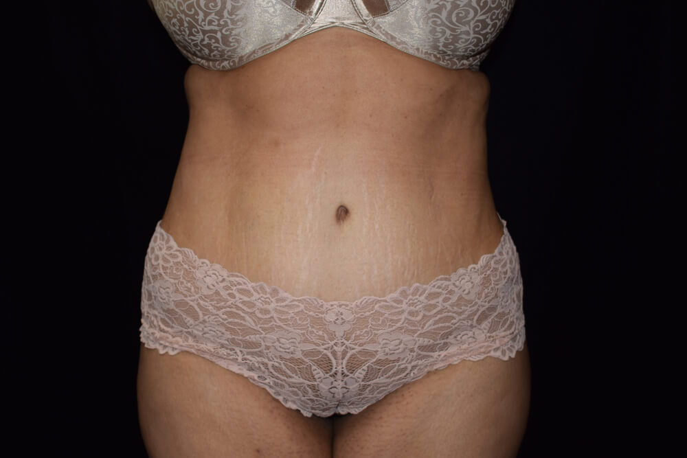 Tummy Tuck (abdominoplasty) - Dr. Joseph A. Racanelli Tummy Tuck (abdominoplasty)