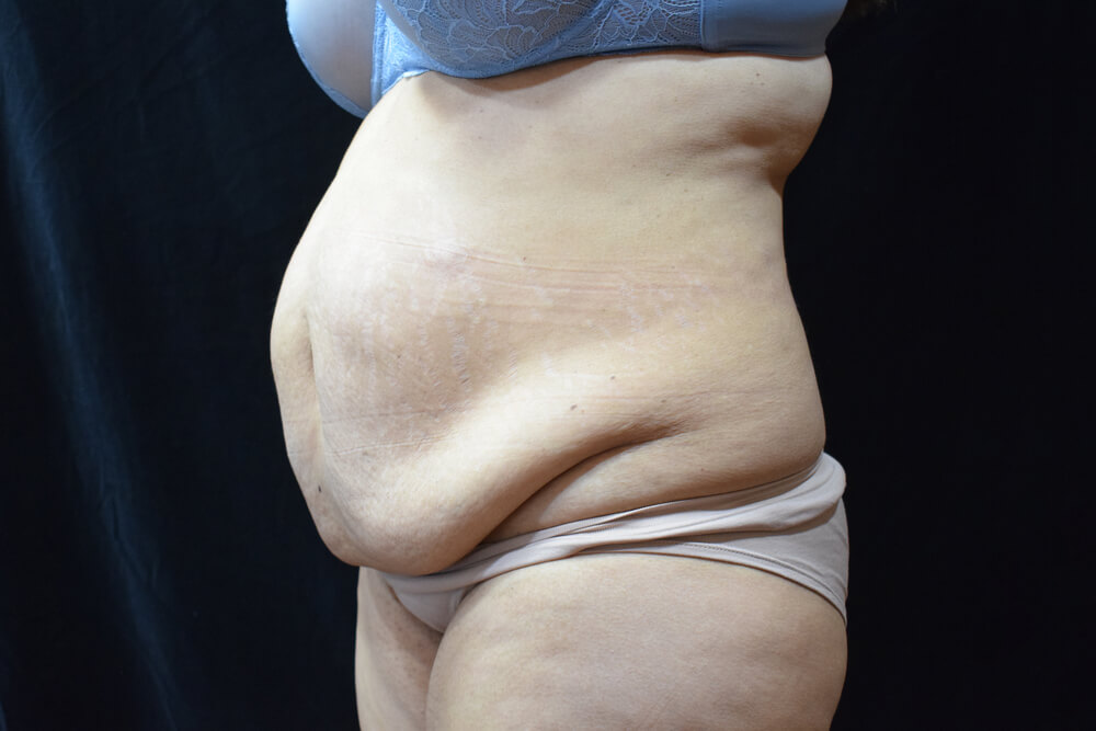 Tummy Tuck (abdominoplasty) - Dr. Joseph A. Racanelli Tummy Tuck (abdominoplasty)