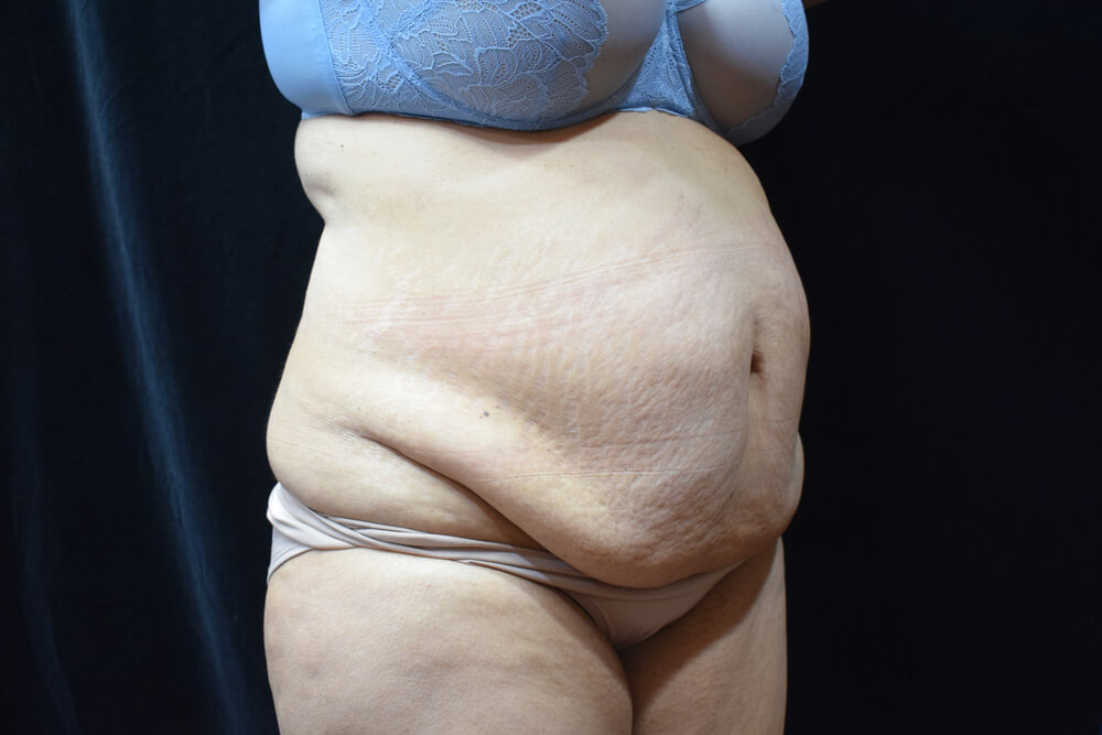 Tummy Tuck (abdominoplasty) - Dr. Joseph A. Racanelli Tummy Tuck (abdominoplasty)