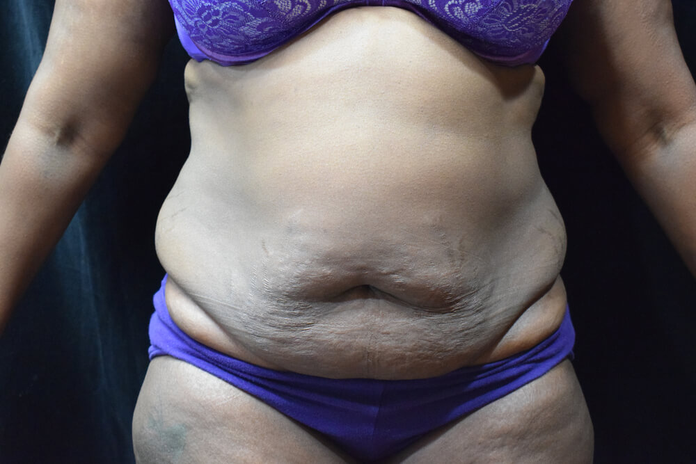 Tummy Tuck (abdominoplasty) - Dr. Joseph A. Racanelli Tummy Tuck (abdominoplasty)