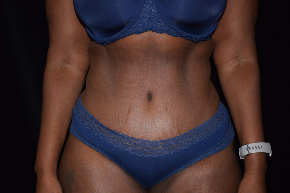 Tummy Tuck (abdominoplasty) - Dr. Joseph A. Racanelli Tummy Tuck (abdominoplasty)