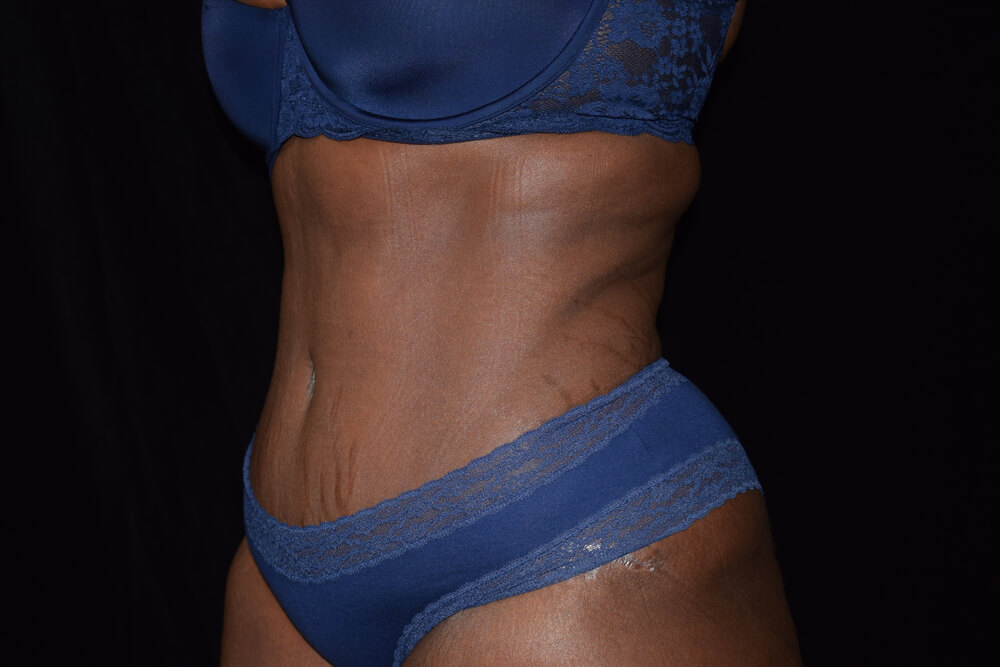 Tummy Tuck (abdominoplasty) - Dr. Joseph A. Racanelli Tummy Tuck (abdominoplasty)