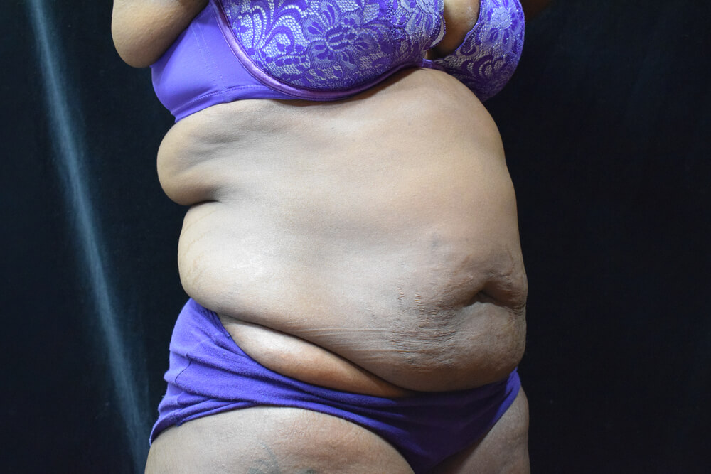 Tummy Tuck (abdominoplasty) - Dr. Joseph A. Racanelli Tummy Tuck (abdominoplasty)