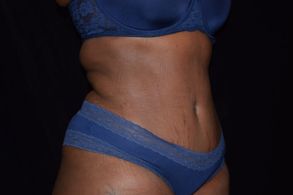 Tummy Tuck (abdominoplasty) - Dr. Joseph A. Racanelli Tummy Tuck (abdominoplasty)